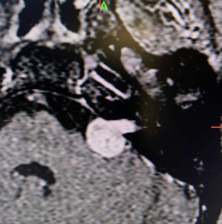 55 year old woman with one year of progressive hearing loss in the left ear / Acoustic Neuroma 1