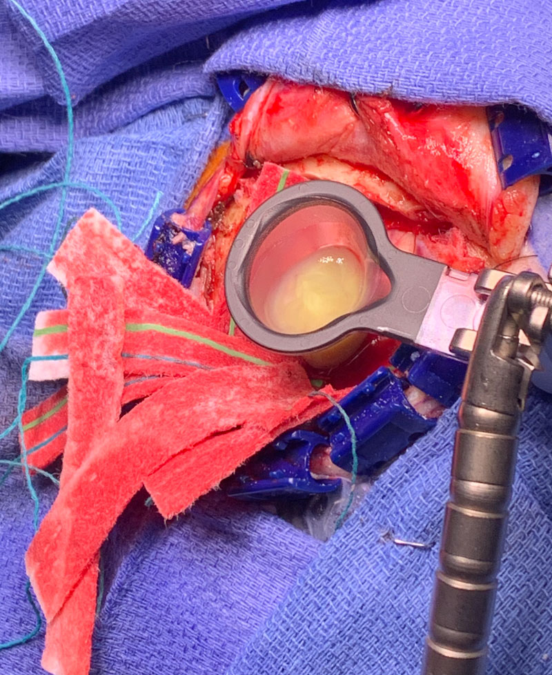Intra-operative image of Vycor tubular retractor in deep left frontal mass with thick purulent material coming out under pressure