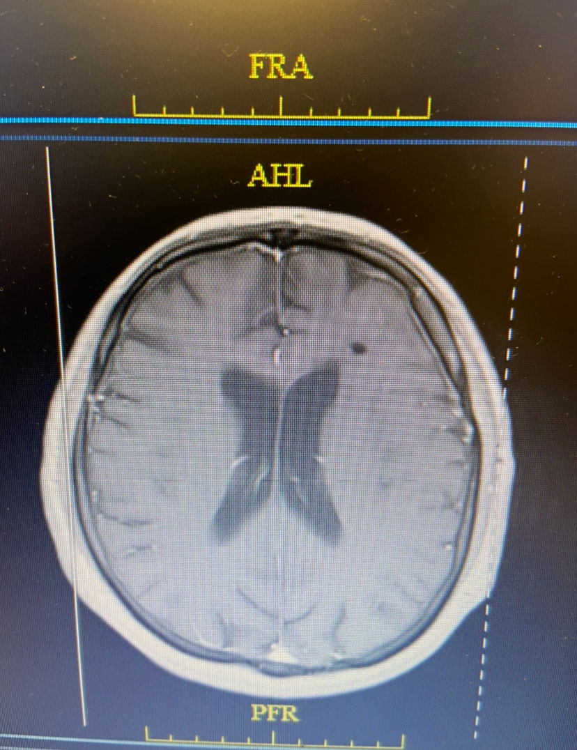 Axial post contrast MRI from 3 months post-op shows resolution of brain abscess and surrounding edema