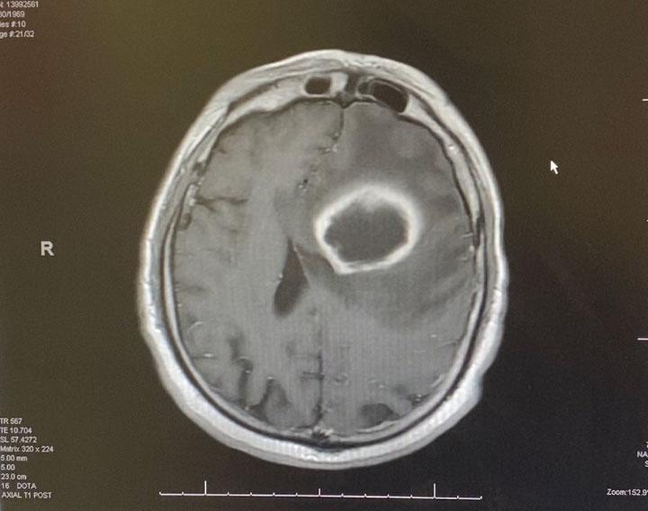 Pre-treatment axial post contrast MRI