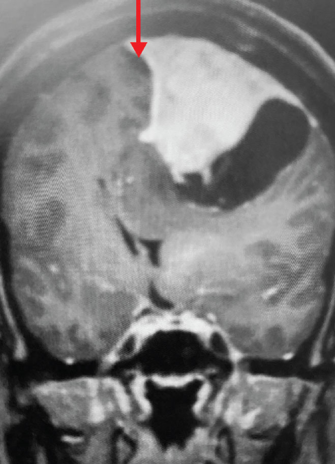 A) Pre-operative, post-contrast, coronal MRI. Arrow points to tumor involvement in the superior sagittal sinus