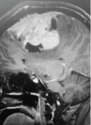 B) Pre-operative, sagittal post-contrast MRI