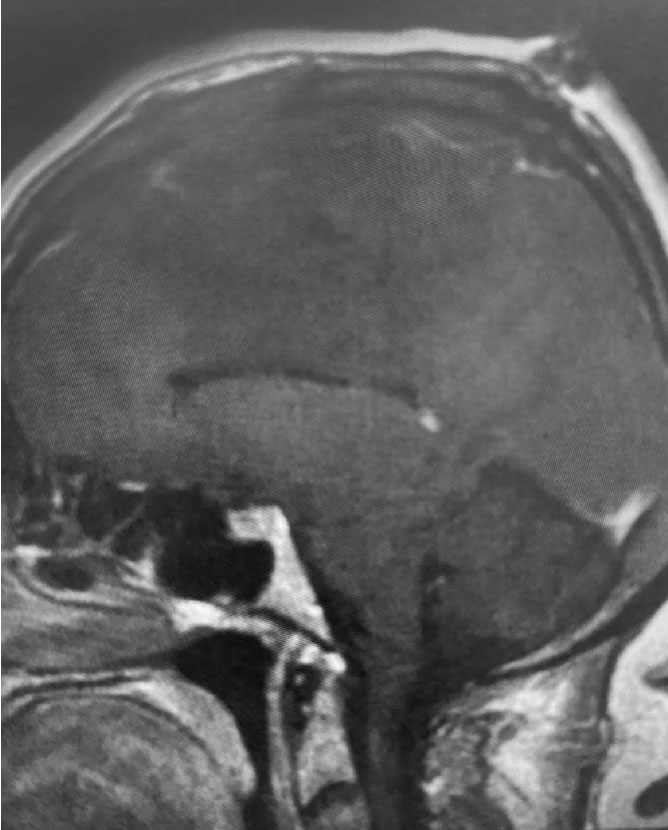 A) Post-operative, post-contrast, sagittal MRI
