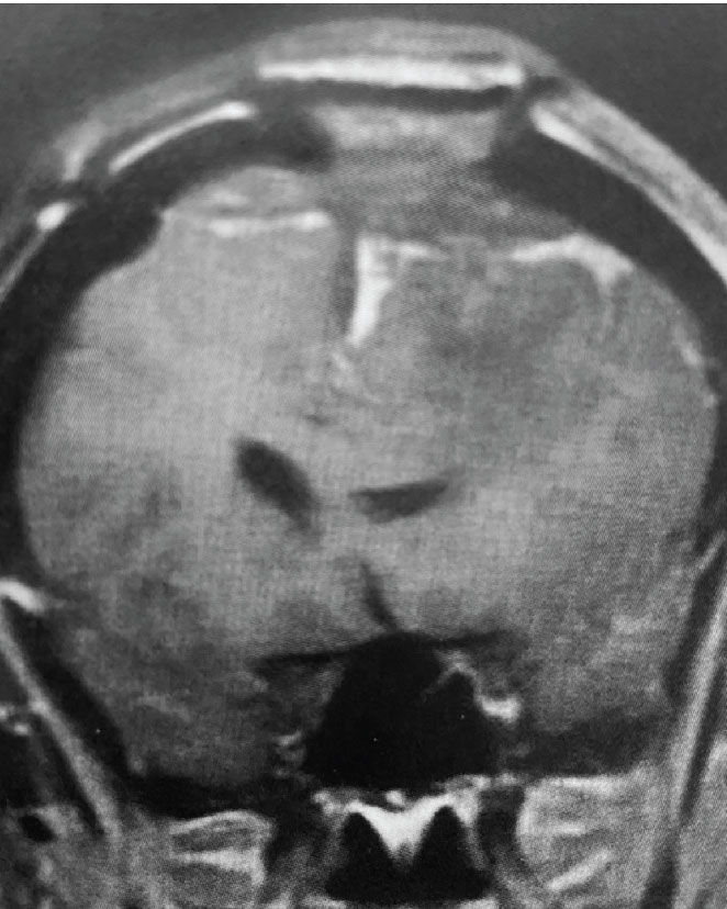B) Post-operative, post-contrast, coronal MRI