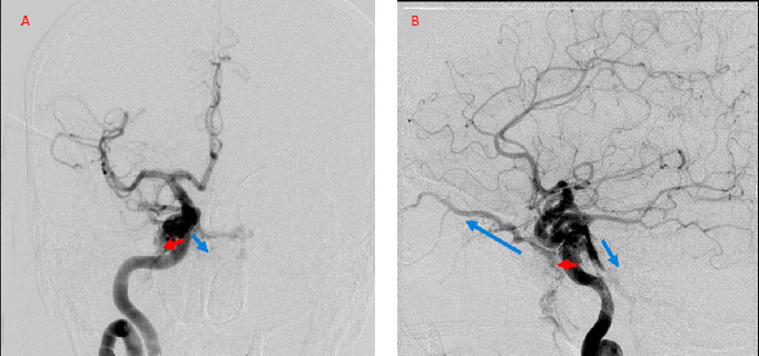 Direct Carotid Cavernous Fistula Ccf Nspc Brain And Spine Surgery