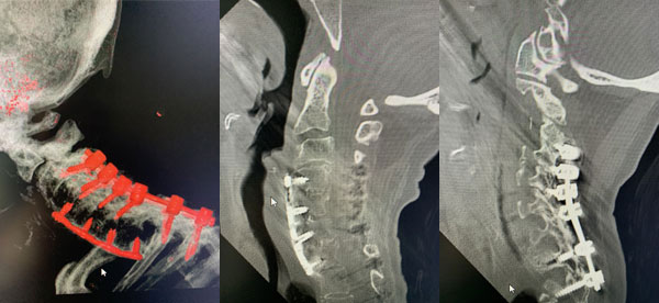 Cervical Laminectomy and Fusion 2