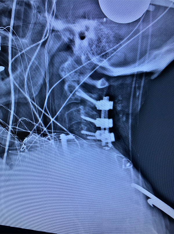 Cervical Laminectomy and Fusion 3