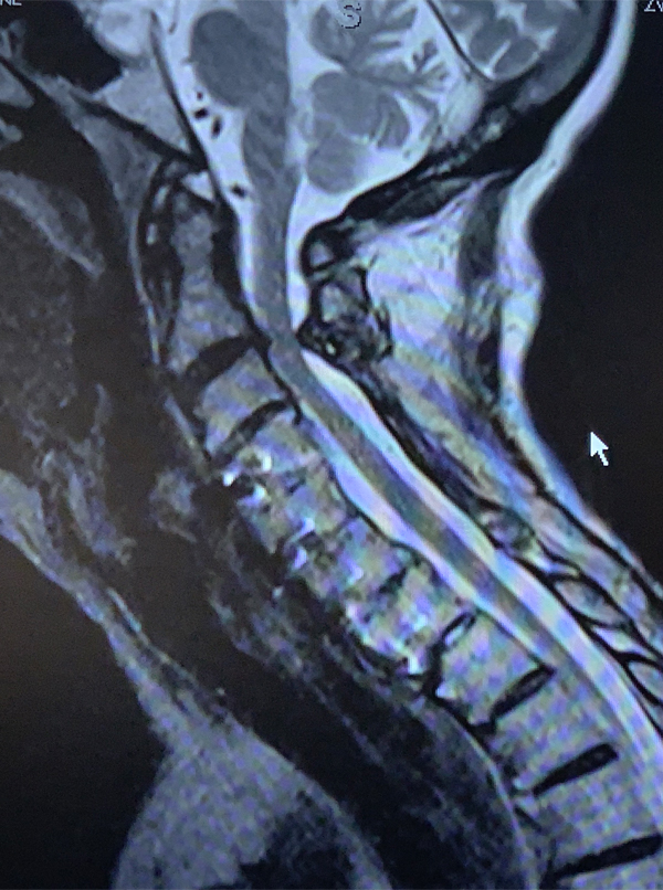 Cervical Laminectomy and Fusion 1