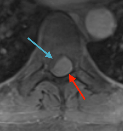Preoperative MRI T1w demonstrating a large enhancing tumor (red arrow) causing severe cord compression and displacement (blue arrow)
