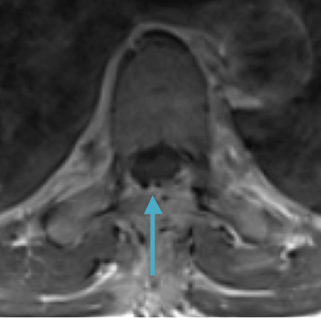 Postoperative MRI T1w demonstrating interval resection with cord re-expansion (blue arrow)