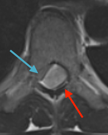 Preoperative MRI T2 demonstrating obstruction of CSF around the cord (blue arrow), resulting from the tumor (red arrow)