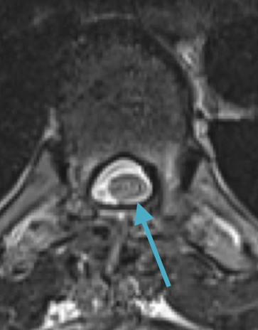 Postoperative MRI T2 illustrating the restoration of CSF surrounding the cord (blue arrow)