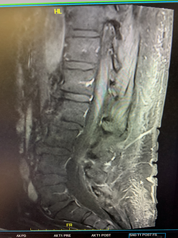 Pre-treatment MRI image of lumbar sacral region