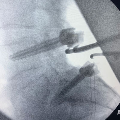 Fluoroscopic sagittal and AP images demonstrating post-pedicle screw placement at L4 and S1