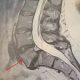 Laminectomy Back Pain Feature