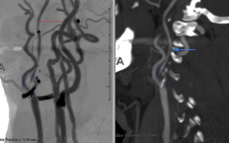 A and B) CTA demonstrating severe ICA 99% stenosis (dotted) with flow-reduced diminution relative to the left ICA (red arrows) and distal plaque extension to C2 level