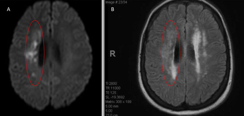 A) MRI Diffusion and B) FLAIR sequence confirm ischemic damage in the right periventricular deep white matter “Watershed” territories