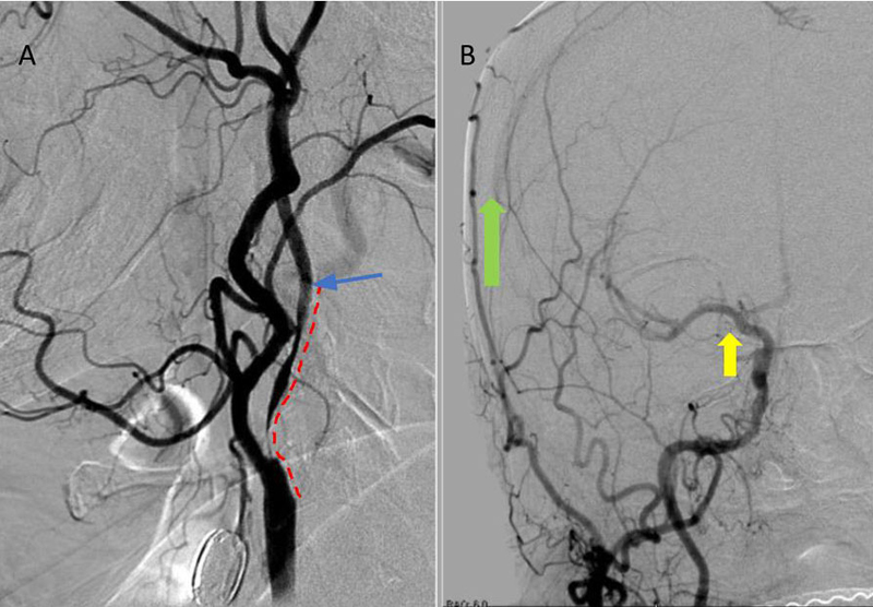 A) DS Angiogram demonstrates severity and extent of plaque to C2-3 level (blue). B) And marked delay of ICA perfusion (yellow) relative to ECA branches (green)