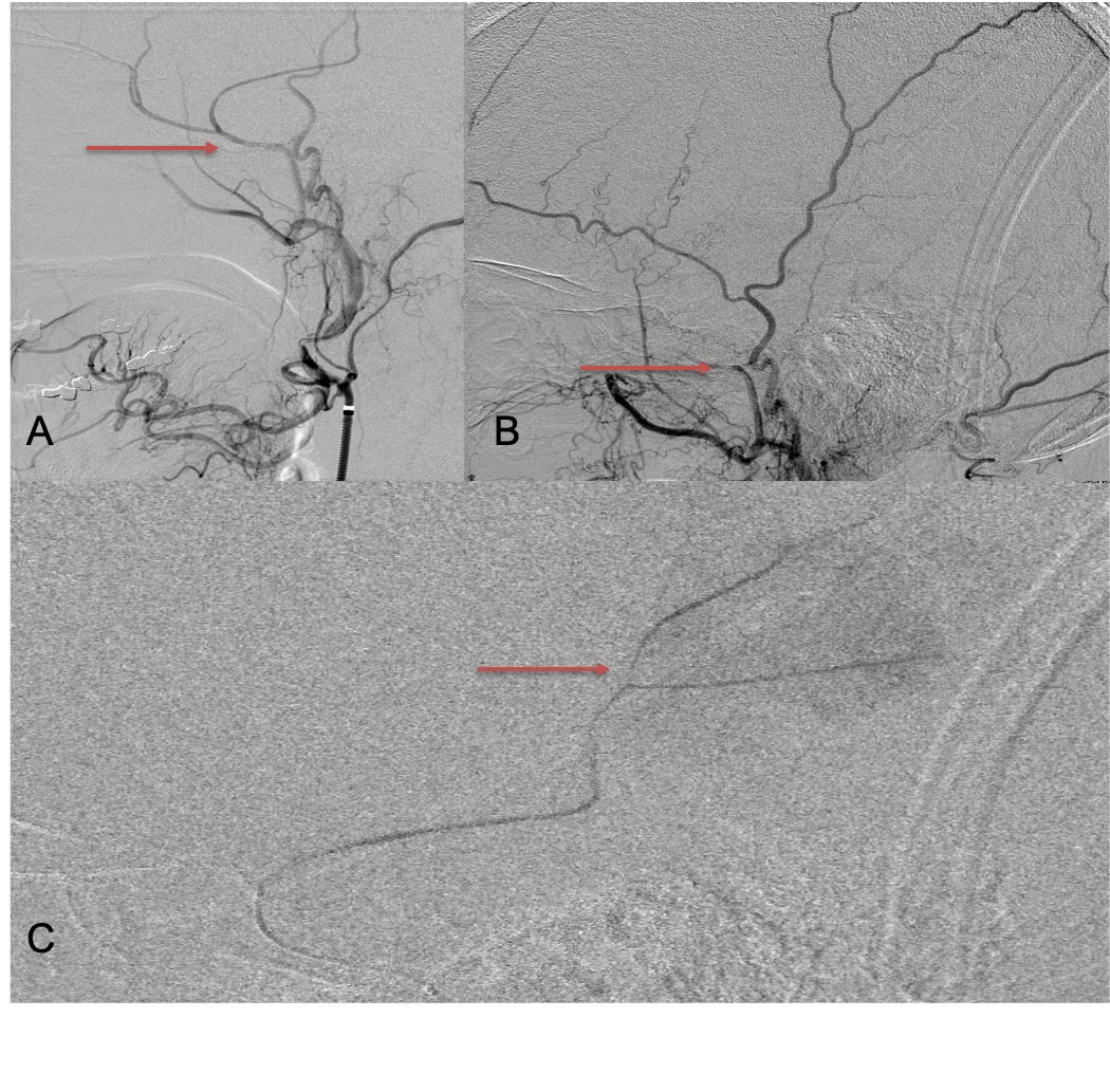 A) Initial right ECA angiogram ; B) Post MMA Embolization; C) Selective Embolization Of Middle Meningeal Artery Membranes using PVA particles (arrows)
