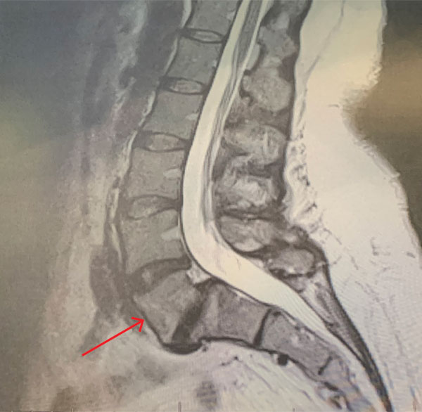 Sagittal MRI T2-Weighted image of lumbar spine demonstrating grade 1 L5-S1 spondylolisthesis and retrolisthesis of L4-5 with significant degenerative disease of both segments