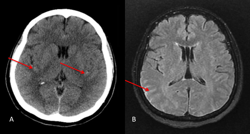 Non Contrast CT and B) MRI FLAIR studies demonstrate subtle Subarachnoid hemorrhage in the sylvian and parietal sulci (arrows)
