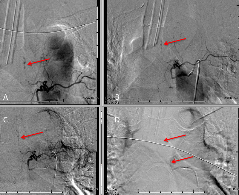 A) Initial left T5 DSA; B) 5 days post; C) Microcatheter DSA D) Post Coil Embolization demonstrating aneurysm obliteration