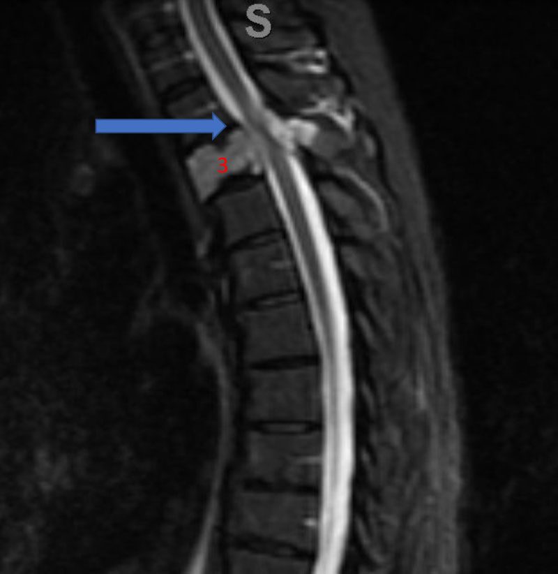 Sagittal T2 MRI demonstrates aggressive hyperintense T3 hemangioma involving the body and posterior elements compressing the thoracic spinal cord (arrows)