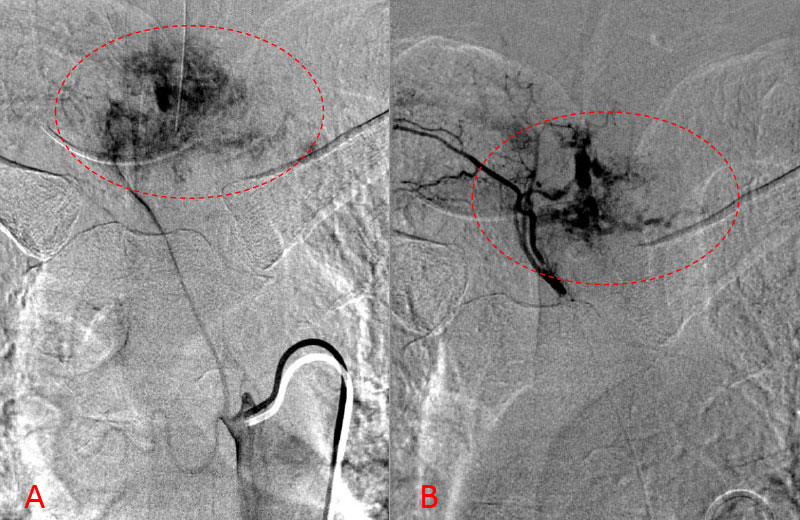 Axial MRI images of T3 demonstrates extensive infiltrative lesion with extradural compression of the thoracic spinal cord. (Dashed lines in A) tumor infiltration; Dashed lines and Arrows in B) cord compression