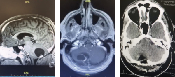 Cerebellar Hemangioblastoma