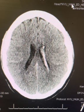 25 year old woman with Brain AVM (arteriovenous malformation) 1