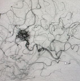 25 year old woman with Brain AVM (arteriovenous malformation) 4