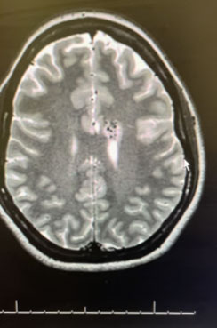 25 year old woman with Brain AVM (arteriovenous malformation) 2