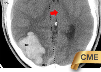 Young college student with severe headache CME Feature