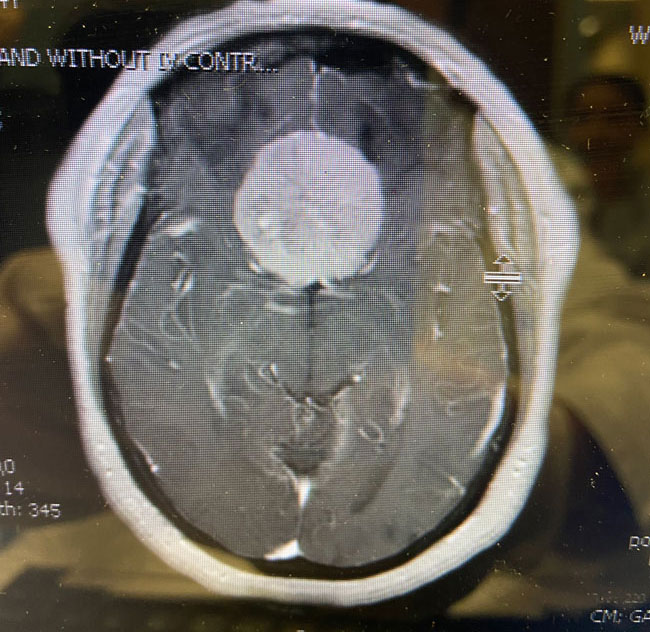 A woman with rapid deterioration in vision – Meningioma 2