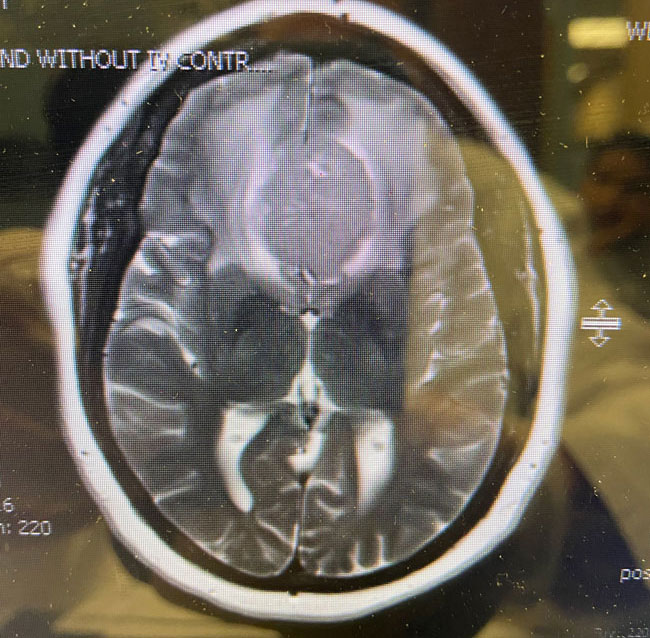A woman with rapid deterioration in vision – Meningioma 3