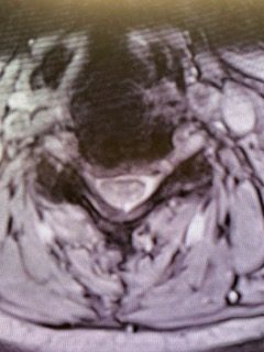 Axial T2 cervical MRI at C4-5 demonstrating significant osteophytic disease with bilateral neural foraminal compression of the C5 nerve roots, right greater than left