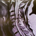 Sagittal T2 cervical MRI demonstrates significant C34 and C45 disc degeneration and osteophyte formation and instability status post anterior cervical discectomy and fusion C5-C7