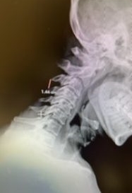 Lateral Flexion cervical x-rays demonstrating 8mm of splaying of the C34 interspinous distance