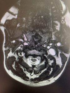 Sagittal and axial T2-weighted cervical MRI demonstrating extensive dorsal epidural collection with hyperintense signal consistent with fluid causing spinal cord compression
