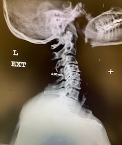 Lateral Flexion cervical x-rays extension image demonstrating 8mm of splaying of the C34 interspinous distance