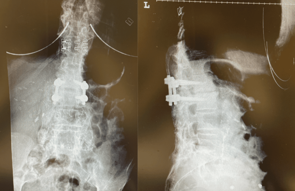 Post Op AP and lateral x-rays after L2-3 instrumented fusion