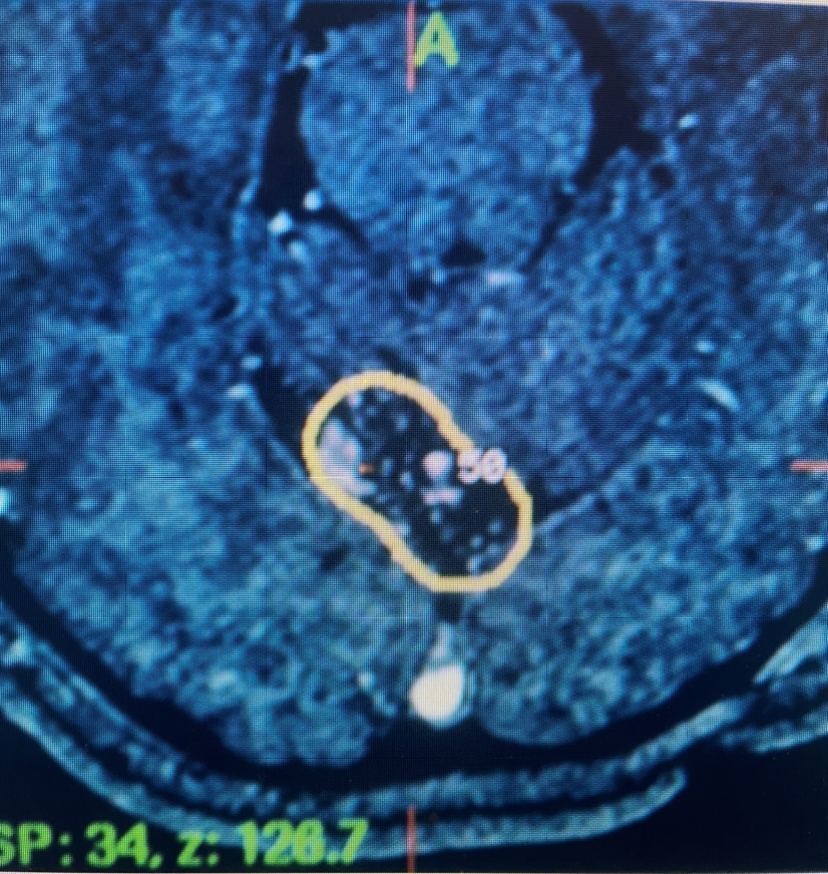 Axial MRI with contrast at the time of gamma knife treatment showing the tightly conformal 50% Isodose line contoured around the AVM of the posterior superior cerebellar vermis