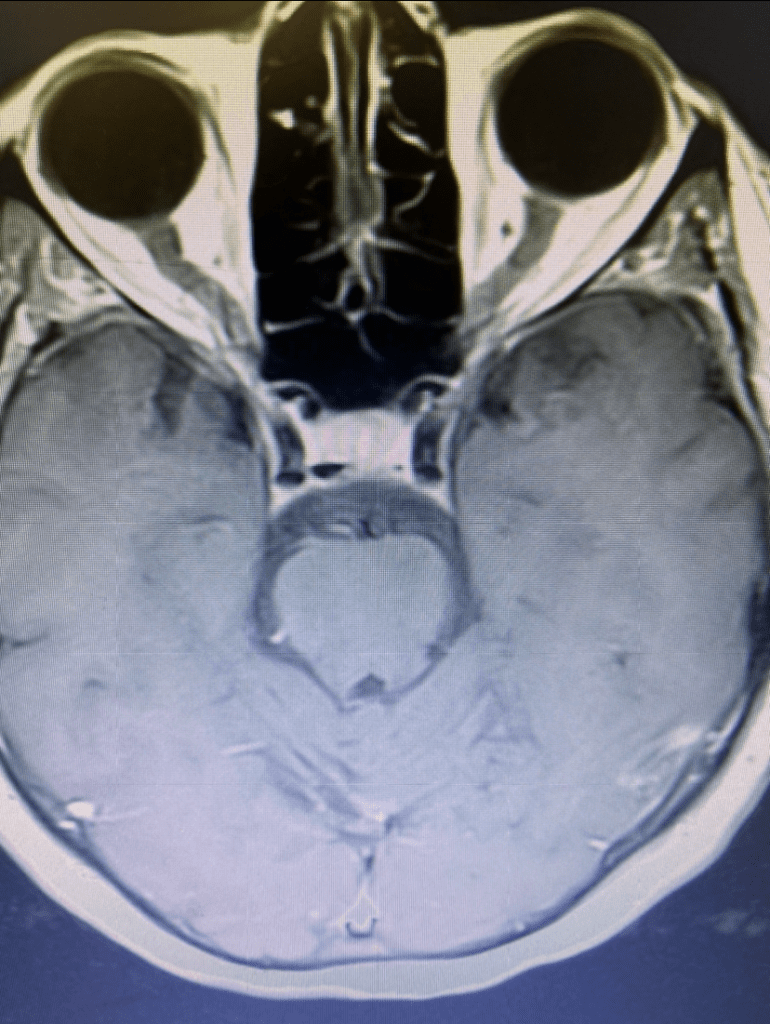 Axial MRI with contrast