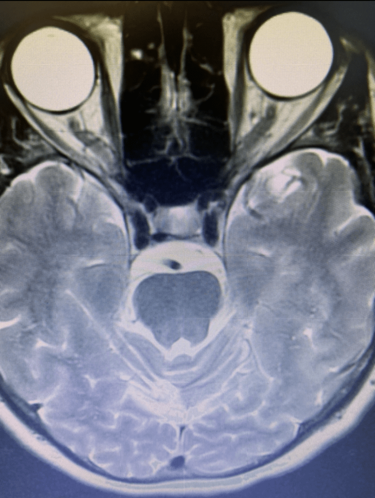 Axial T2 MRI