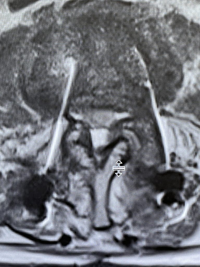 Axial T2 MRI of the lumbar spine demonstrating L2-3 stenosis due to significant facet arthropathy