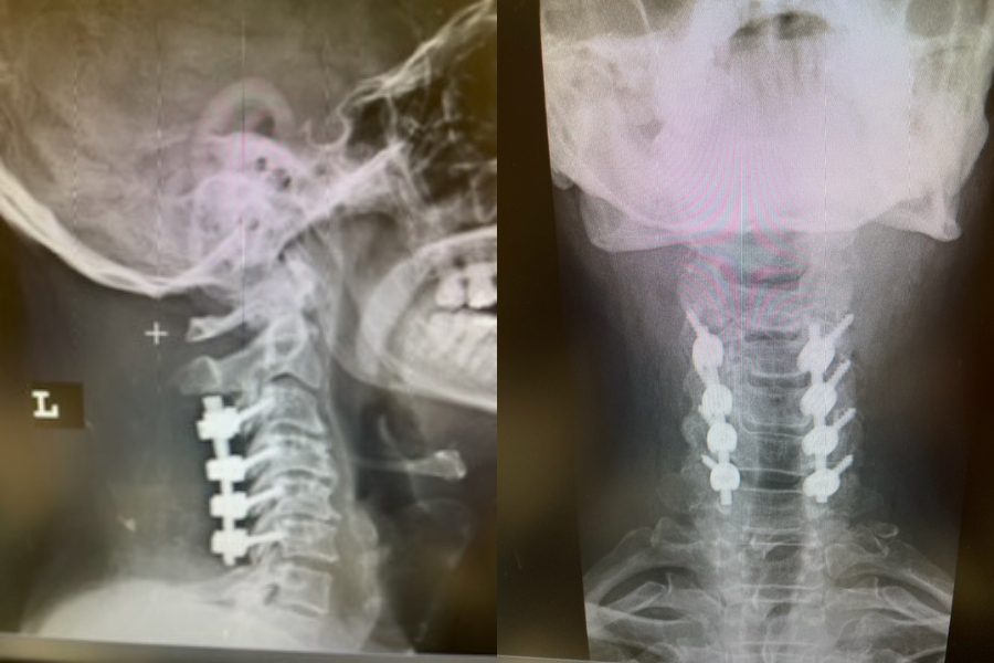 Post operative AP and lateral cervical x-ray demonstrating good placement of hardware and alignment