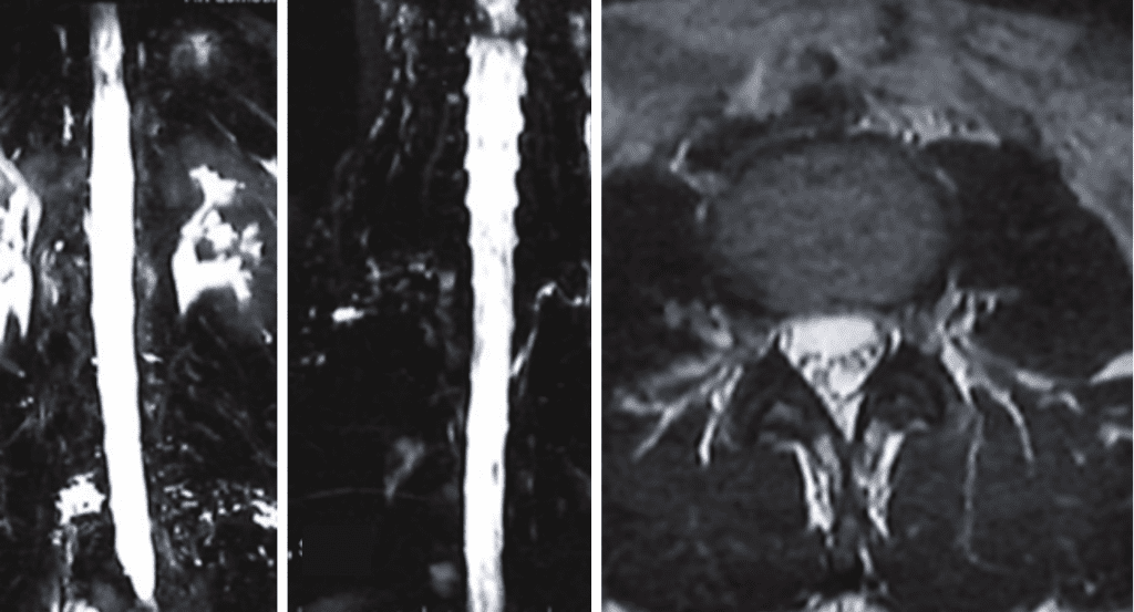 MRI myelogram with fat saturation showing multiple fluid areas along nerve root areas in the high and low lumbar region, consistent with CSF leaks