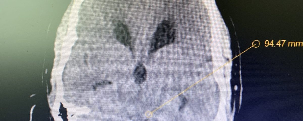 IMG 3734 JLB 2022 Brainstem Tumor EBlast Photo 2 scaled e1649447573169