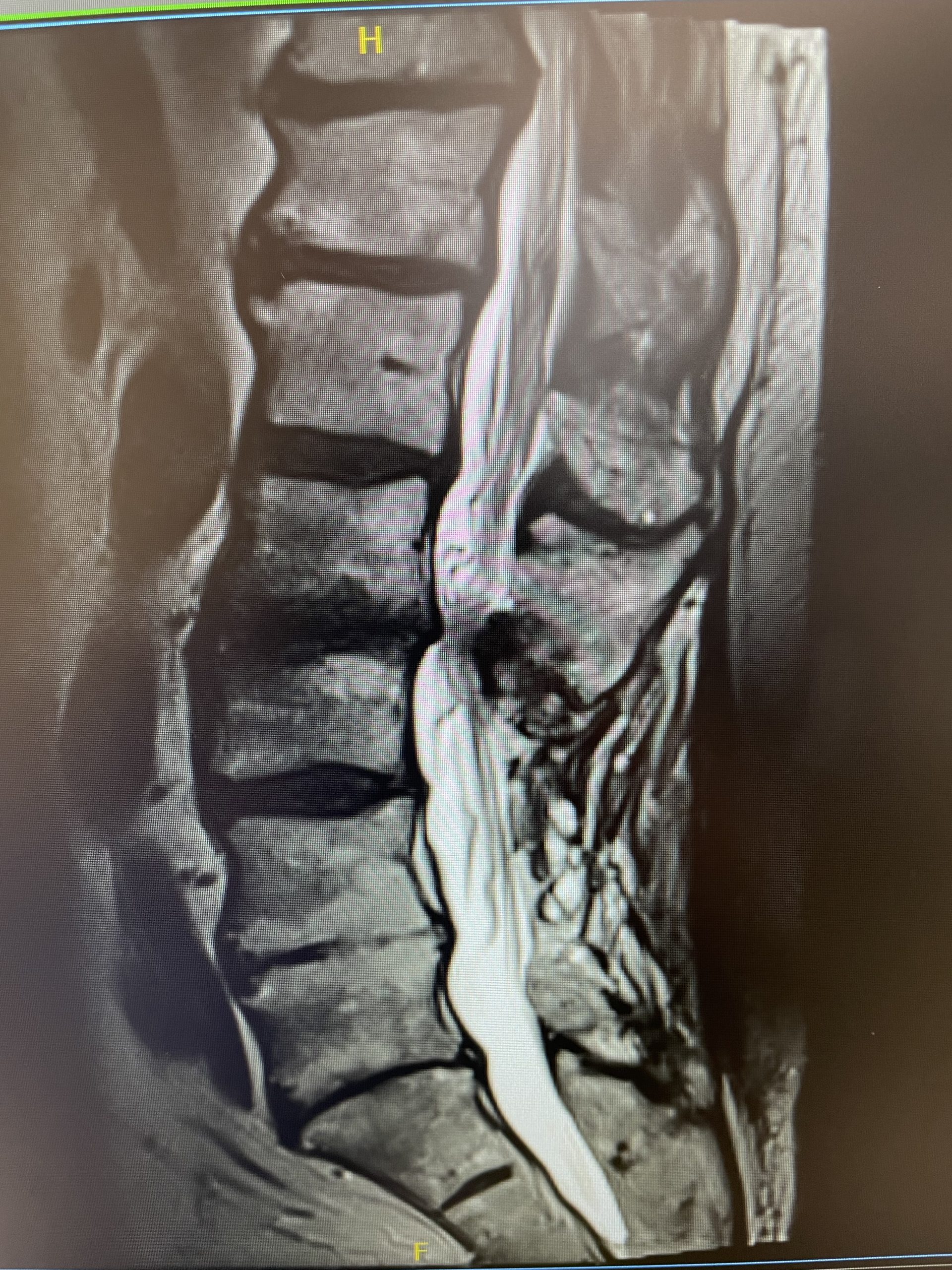 Lumbar Spinal Stenosis - Tidewater Physicians Multispecialty Group