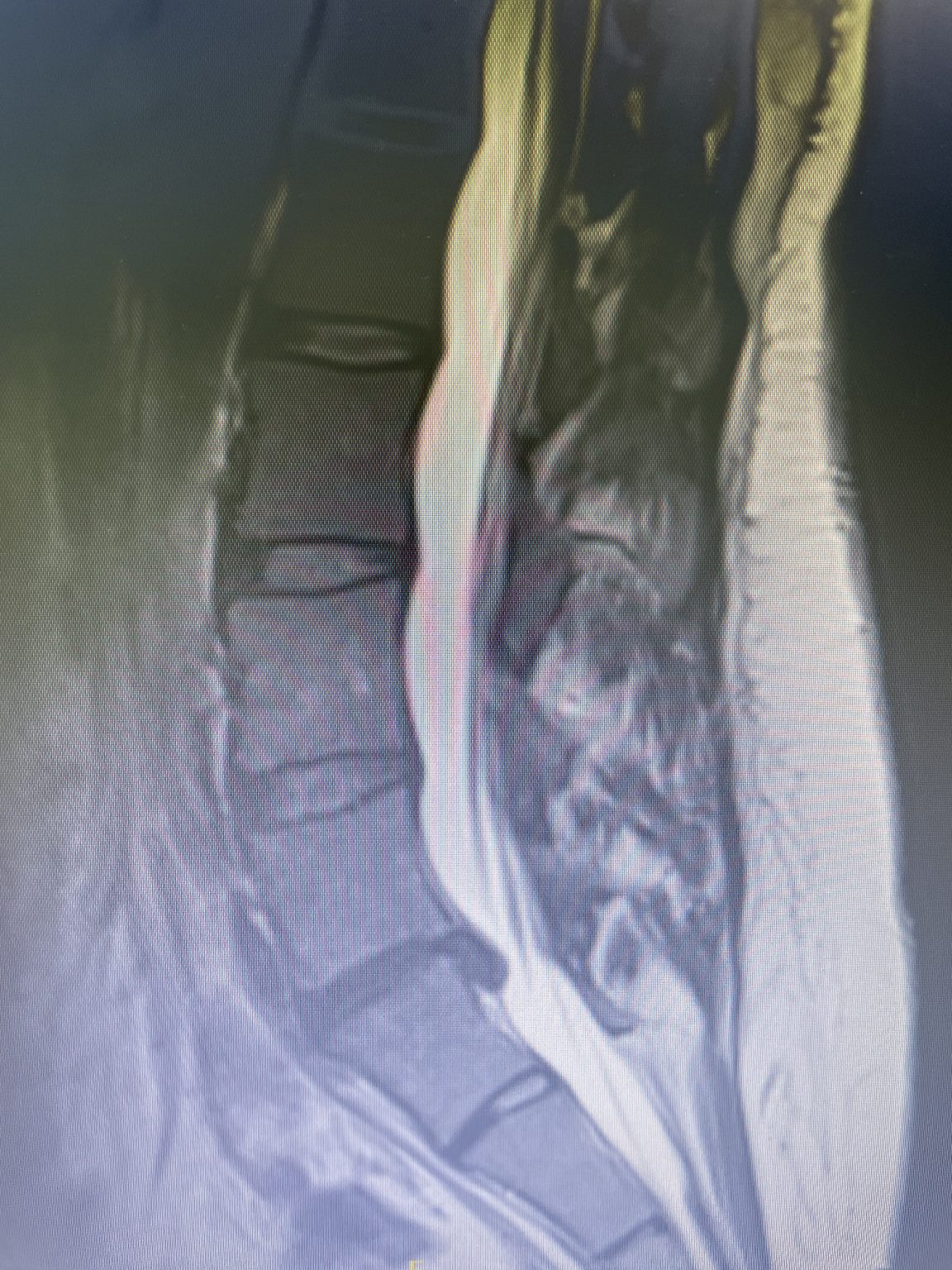 Transitional Lumbar Segment NSPC Brain & Spine Surgery